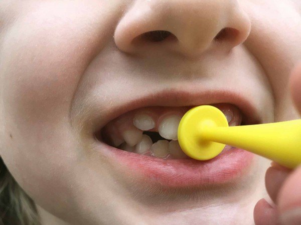 proButton - pour fermeture des lèvres/épaisseur (set de 2)